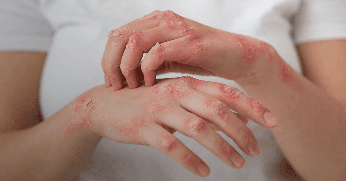 Lúpus afeta principalmente mulheres jovens e ainda enfrenta desafios no diagnóstico e tratamento