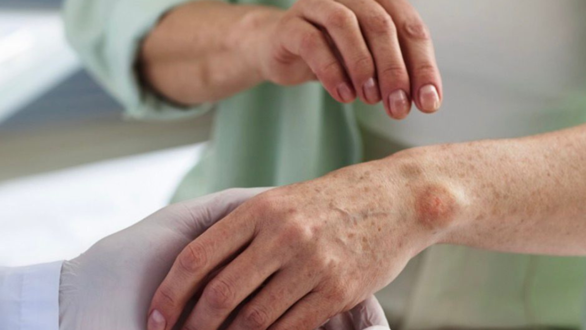 Janeiro Roxo reforça alerta para hanseníase e diagnóstico precoce no DF