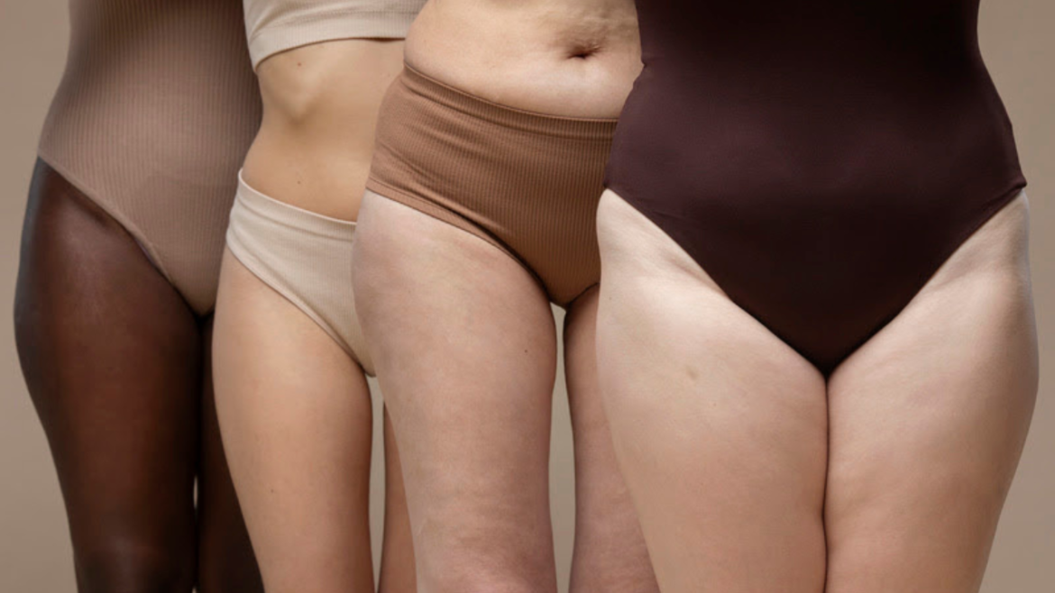 Sociedade Brasileira de Angiologia e Cirurgia Vascular alerta sobre lipedema, diagnóstico revelado pela apresentadora Rafa Brites